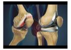 Top Knee Replacement Surgeon in Vaishali Nagar – Dr. Arvind Asopa